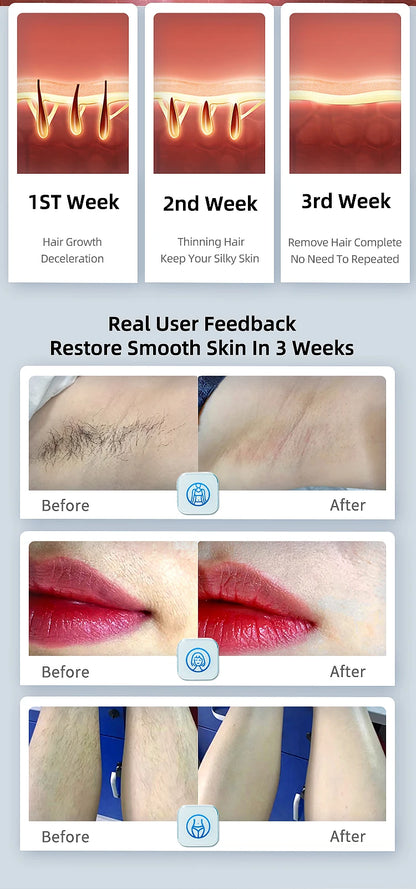 MLAY T14 Laser Hair Removal Ice Cooling IPL Laser Epilator Bikini Body Laser Depilador for Women Replaceable Lamp Hair Removal